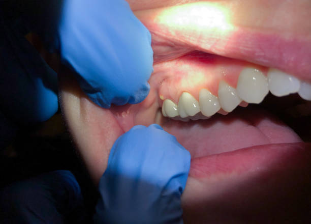 Best Emergency Dentist for Knocked-Out Tooth in Blennerhassett, WV